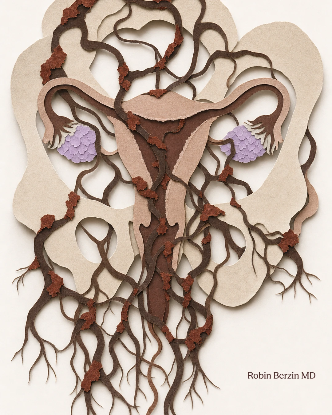 Endometriosis lesions represented as invasive vines taking root throughout the pelvis.