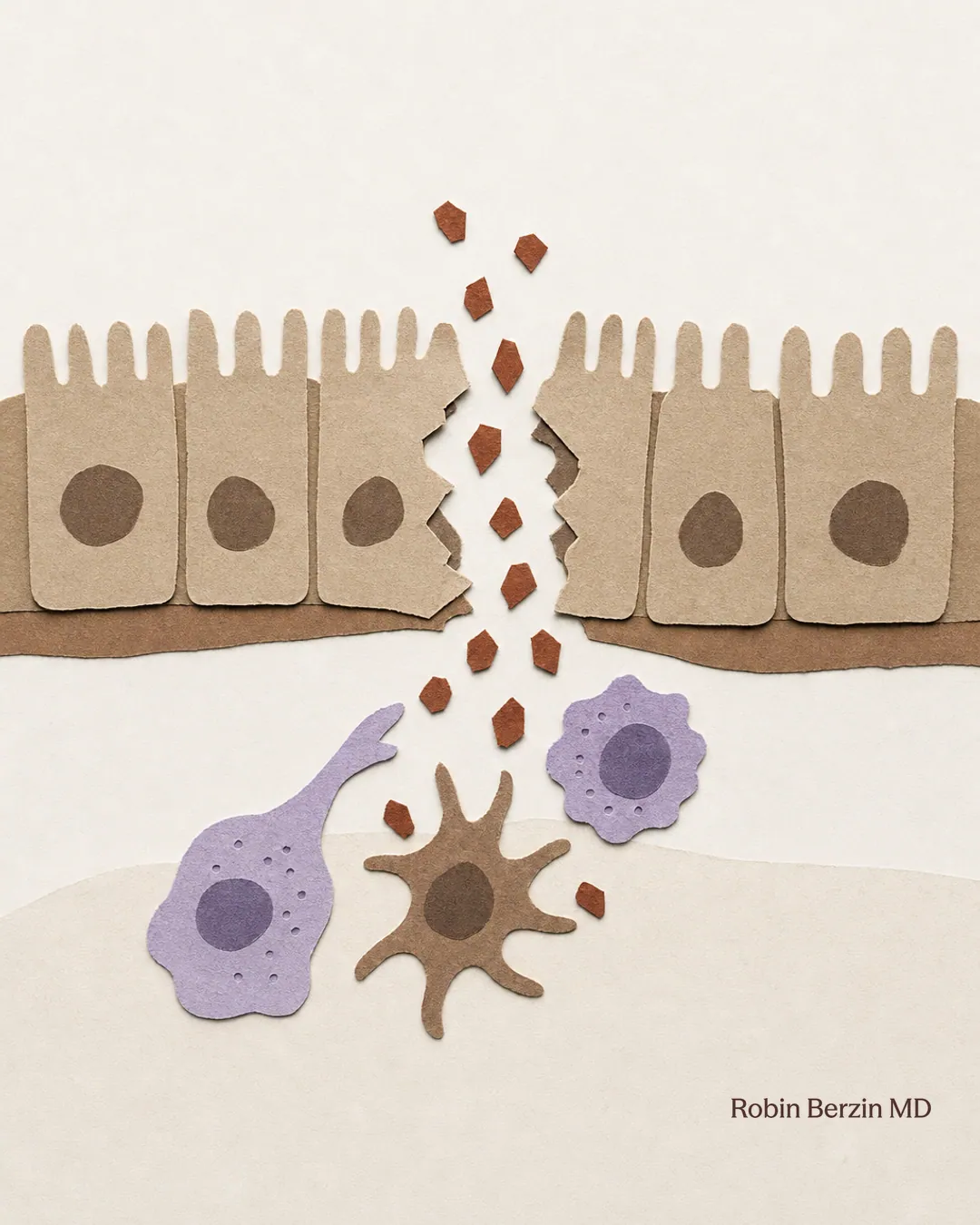 An intestinal barrier with loosened seals allowing food fragments to reach immune cells.